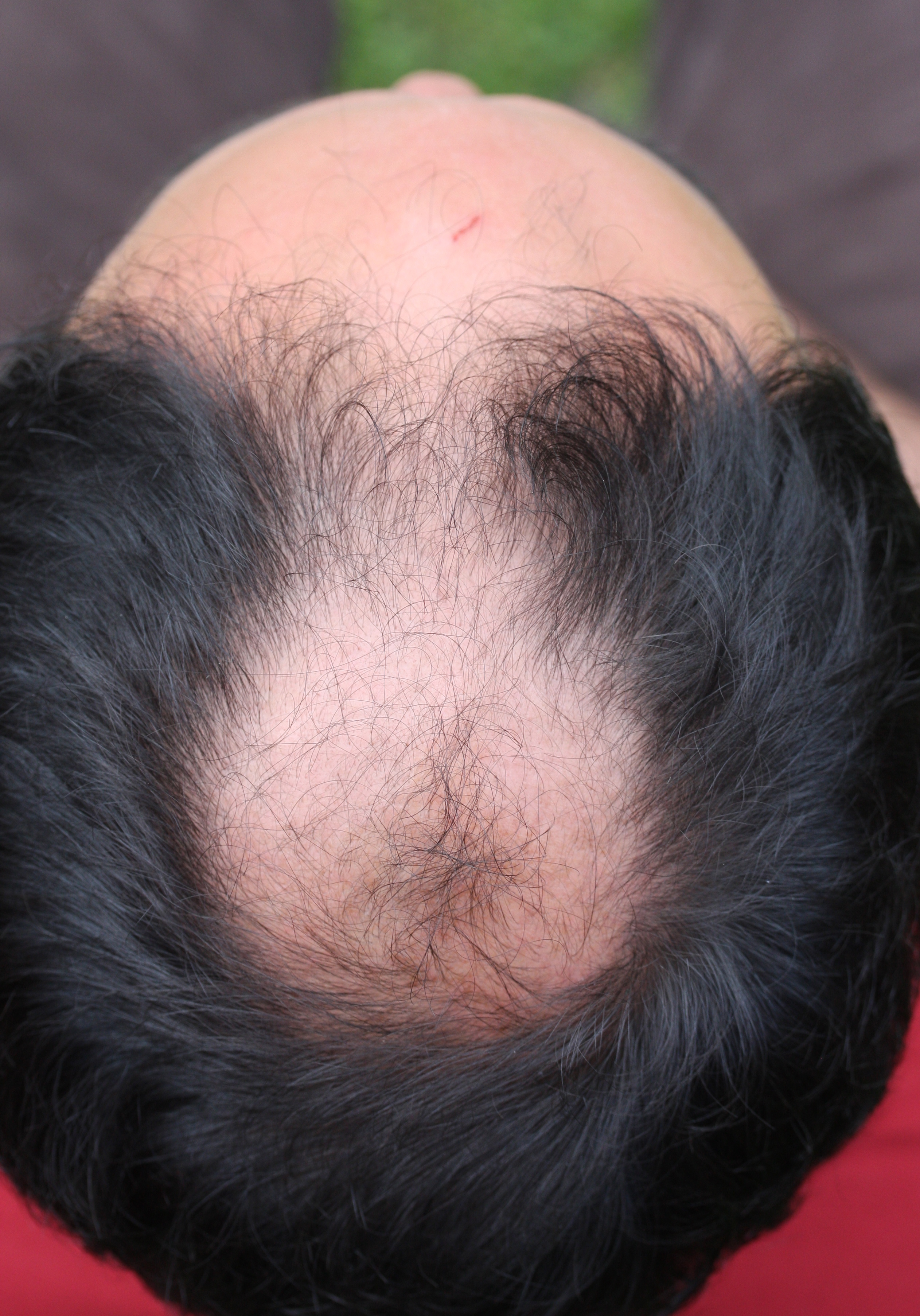 what happens if i use rogaine for frontal baldness