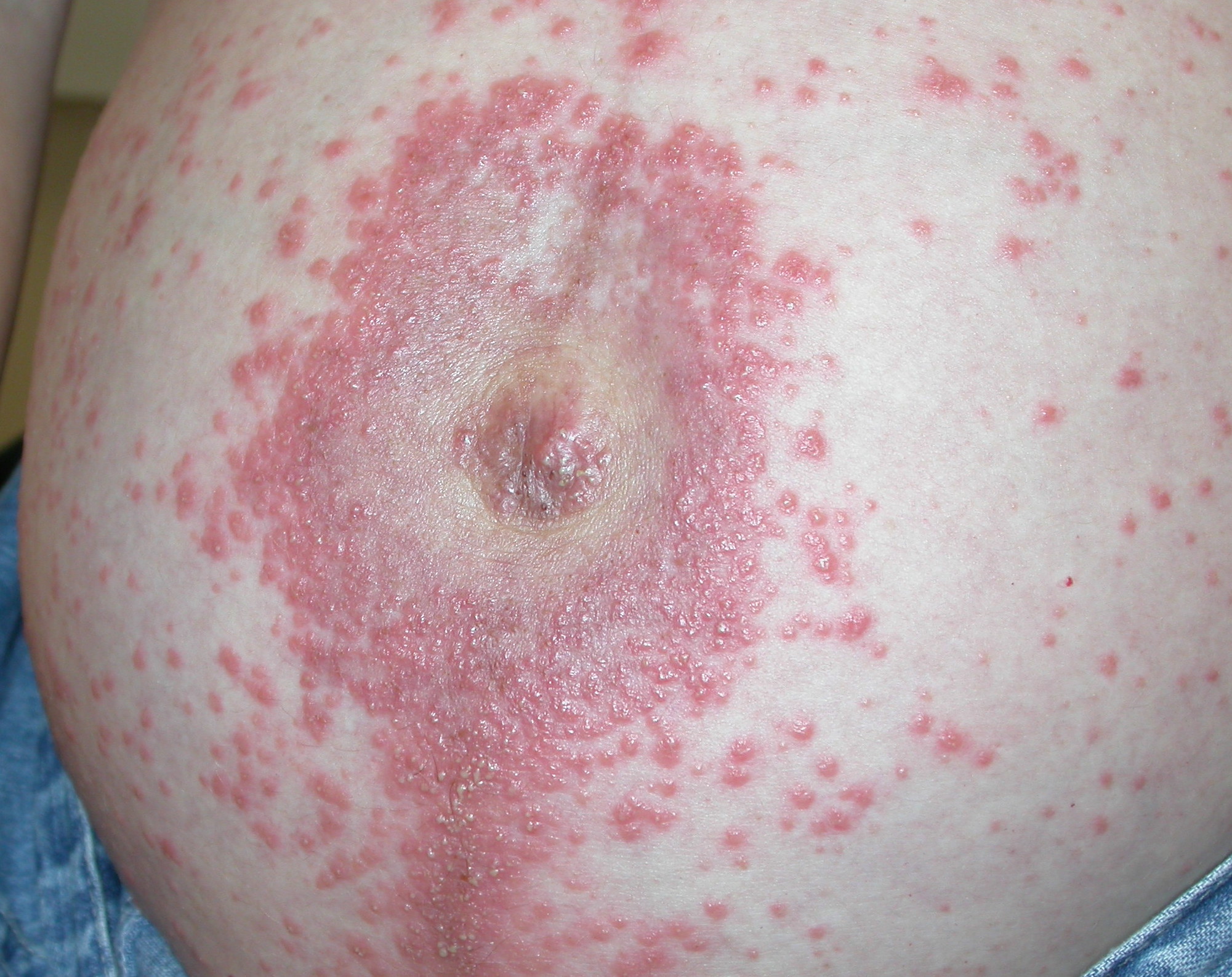 Pruritic Urticarial Papules and Plaques of Pregnancy