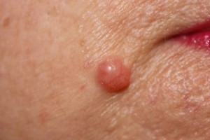 Basal Cell Carcinoma (rodent ulcer)