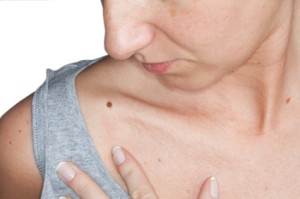 Moles should be checked by your dermatologist