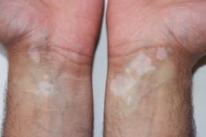 Patches of vitiligo