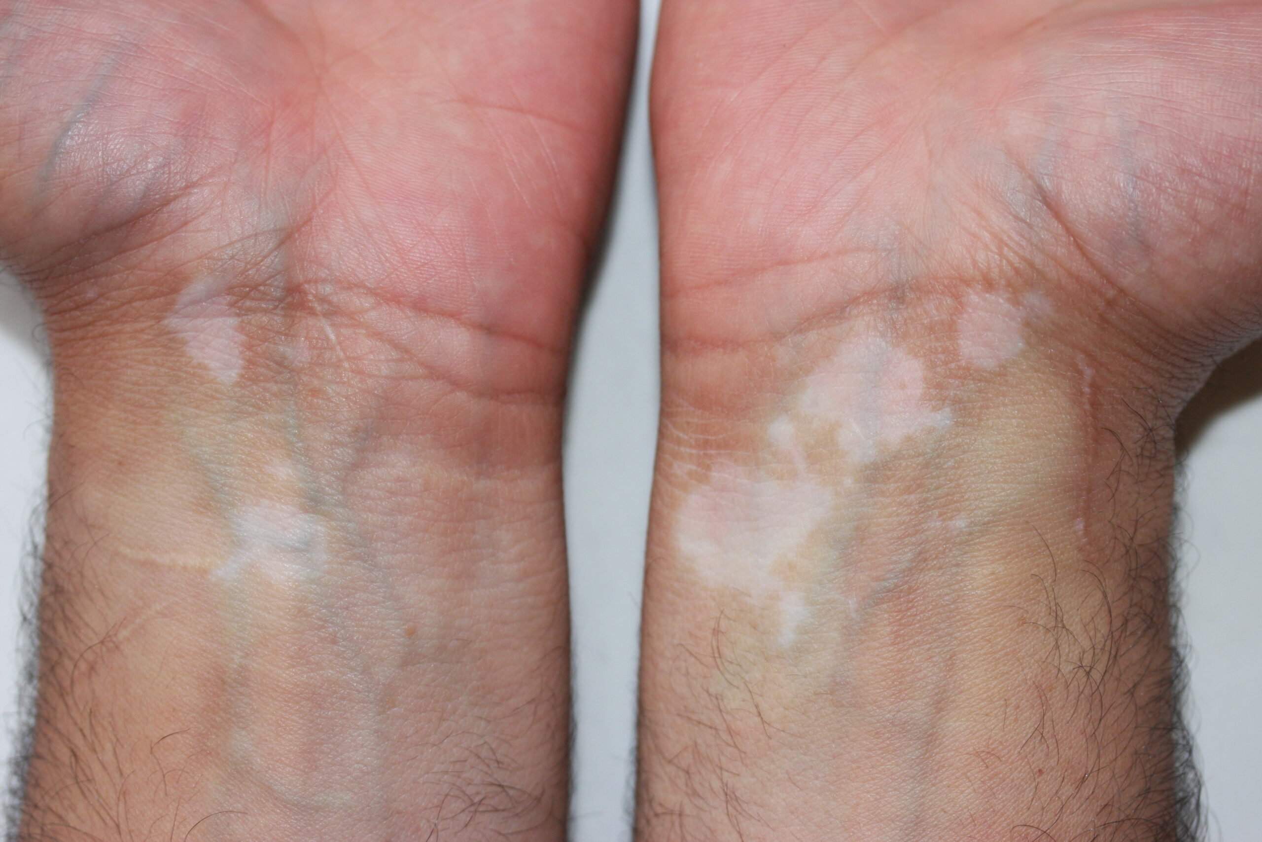 Patches of vitiligo