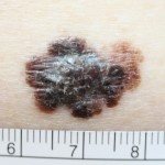 A melanoma