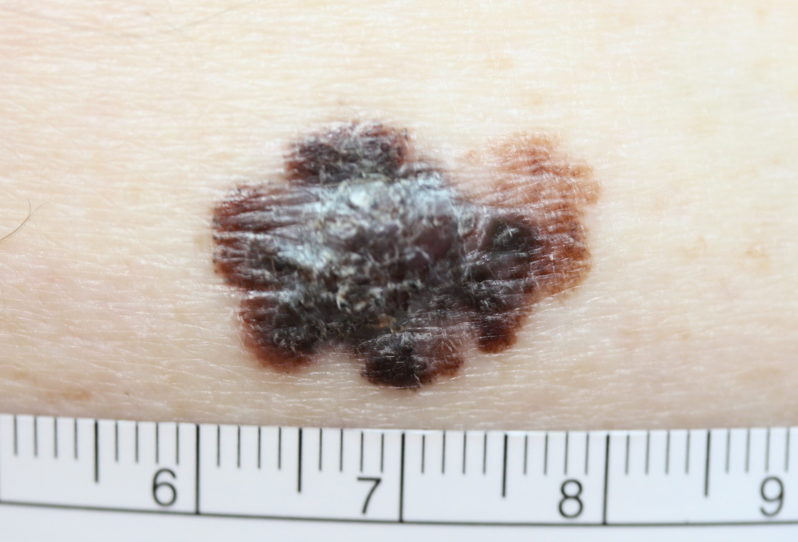 A melanoma