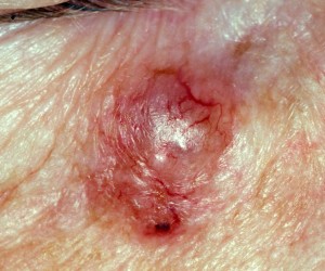 Basal cell carcinoma