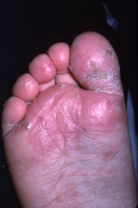 Juvenile plantar dermatosis