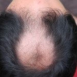 Vertex and frontal baldness