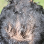 Mild vertex baldness
