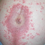 Pemphigoid gestationis