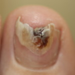 Fungal nail infection