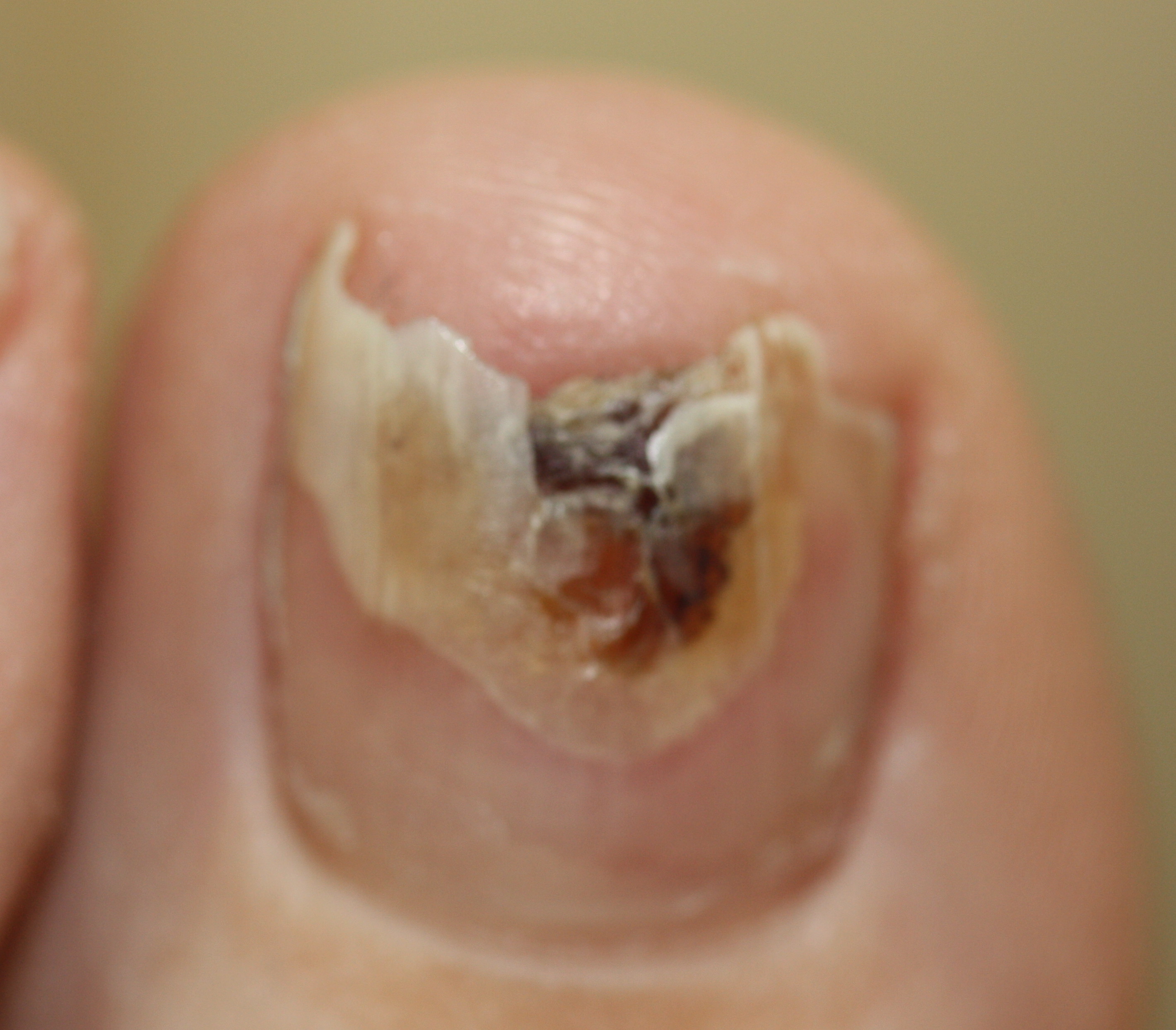 Fungal Nails Management in Singapore - Straits Podiatry