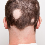 Alopecia areata